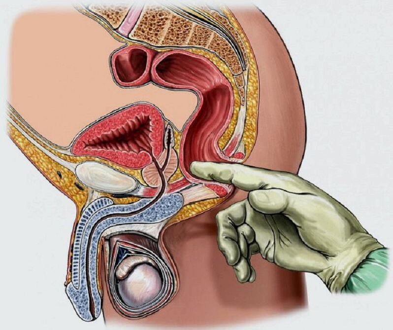 Massaggio prostatico per prostatite